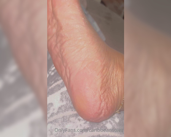 Caribbean Solez aka Caribbeansolez OnlyFans - Foot peel update…day 3 and they are looking dry af but going to trust the process Can you moistu