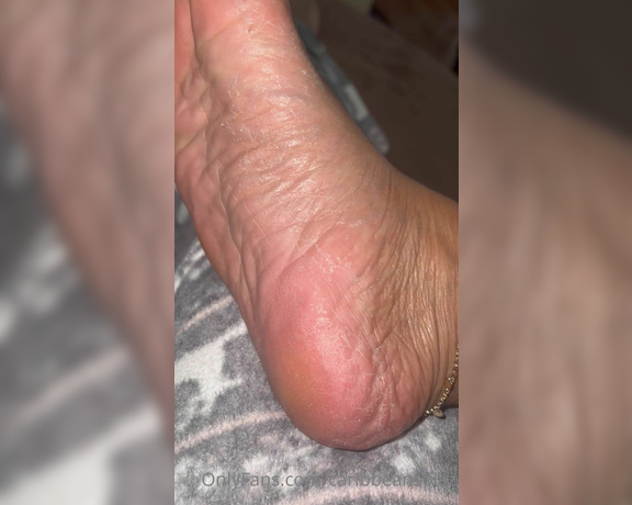 Caribbean Solez aka Caribbeansolez OnlyFans - Foot peel update…day 3 and they are looking dry af but going to trust the process Can you moistu