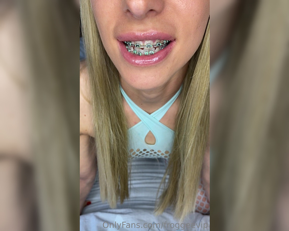 Froggee aka Froggeevip Onlyfans - Braces